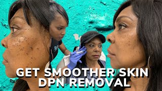 DPN removal for smoother skin