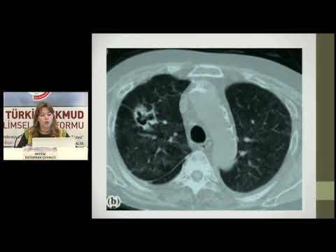 25 sitomegalovirus enfeksiyonu