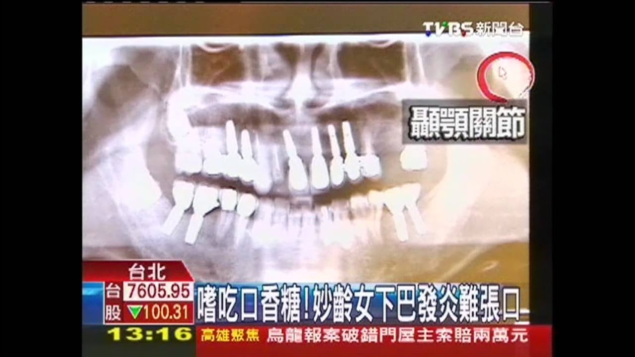 嗜吃口香糖! 妙齡女下巴發炎難張口