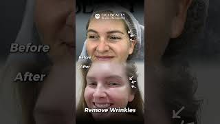 Botox 3 Areas at Cici Beauty – Wrinkle Reduction in Hanoi

B…