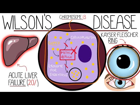 Understanding Wilson s Disease Hepatolenticular Degeneration