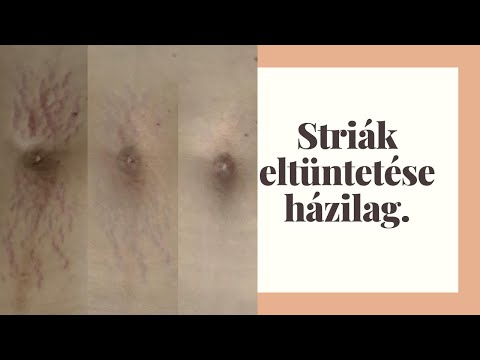 Striák eltüntetése - Hegek kezelése