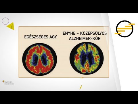 A dohányzás alzheimer kórhoz vezet, Az aggregatin okozhatja a fehérjelerakódásokat Alzheimer-kórban