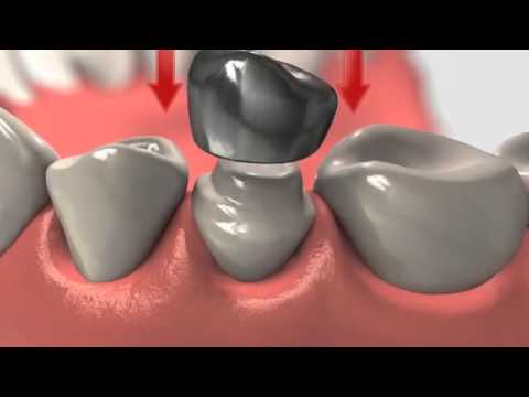Dental Crown : Crowns And Root Canal Treatment Video