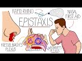 Understanding Epistaxis Nosebleeds Explained