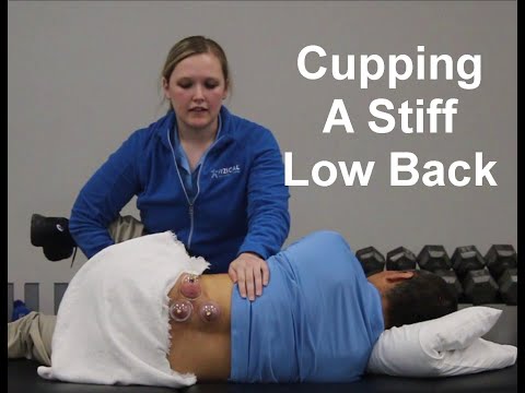 Advanced Cupping Techniques (Myofascial Decompression) for a Stiff Low back (LBP)
