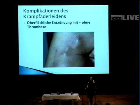 Wenn die Venen leiden Krampfadern und Thrombose — Bedrohung der Beine