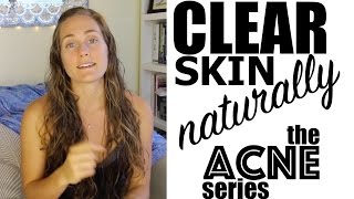 Cure Chronic Acne Naturally Part 1 - Diet, Exercise, Lifestyle - The Acne Series