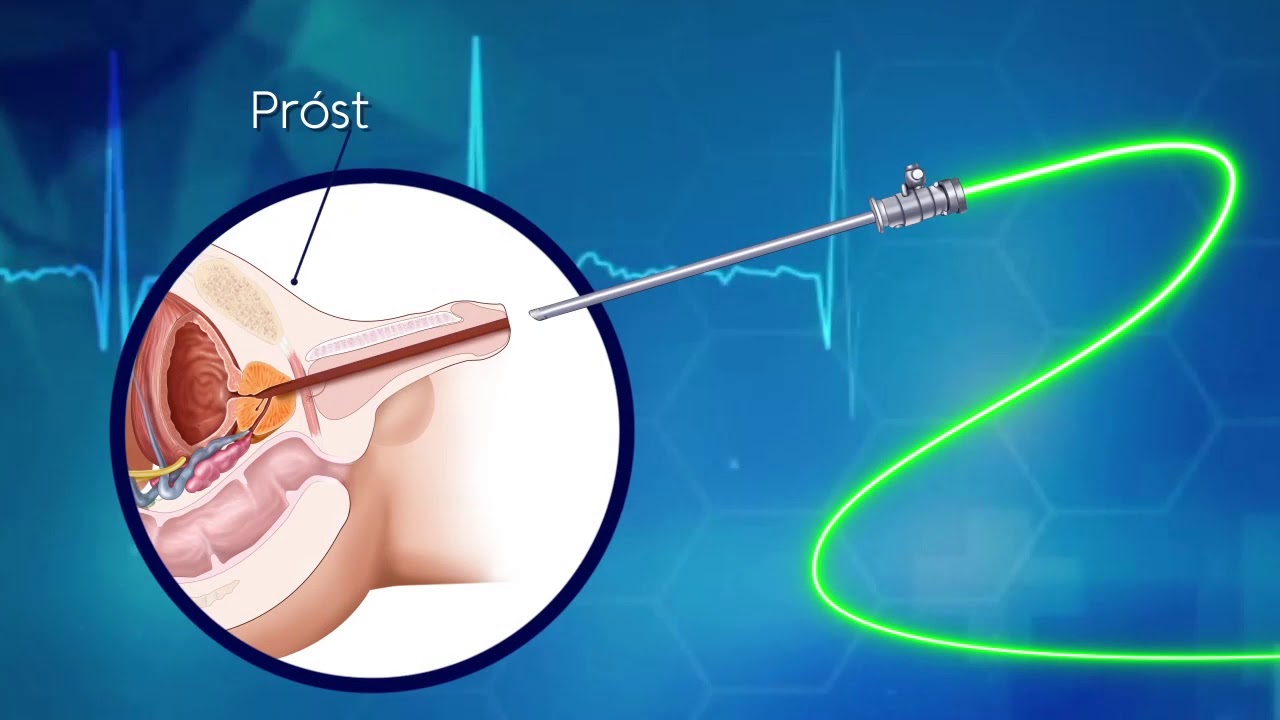 CIRUGÍA DE PRÓSTATA CON LÁSER VERDE