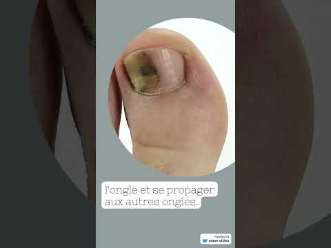 Vidéo : mycose d'ongle expliquée par le dermatologue