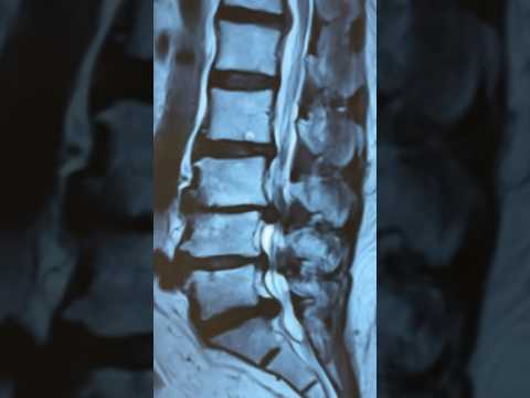 Multilevel lumbar spine canal stenosis treatment : Can paralysis be reversed ?