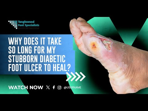 Understanding and Treating Diabetic Foot Ulcers: A Comprehensive Guide