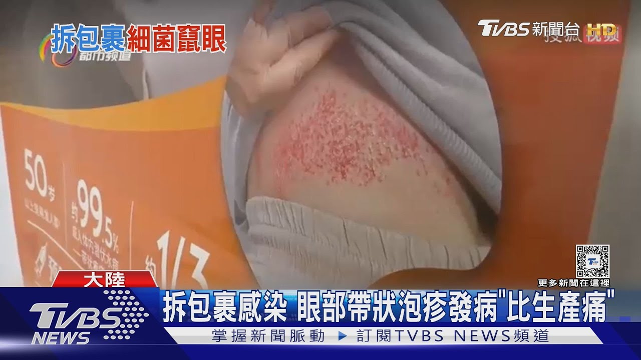 拆包裹沒洗手揉眼睛 陸65歲婦眼染皰疹