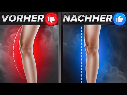 X-Beine korrigieren (Knie kollabieren nach Innen + Schmerzen)