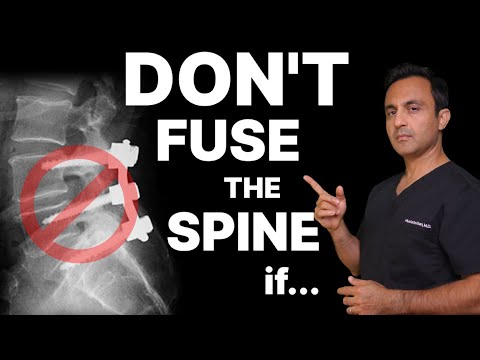 When you DON'T need a spinal fusion