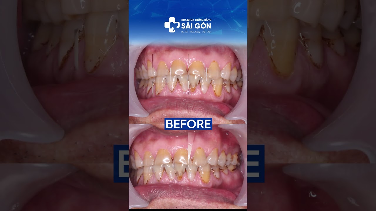 Case Bọc 24 Răng Sứ Hết Ê Buốt, Mòn Cổ Chân Răng | Nha Khoa Trồng Răng Sài Gòn #rangsuthammy