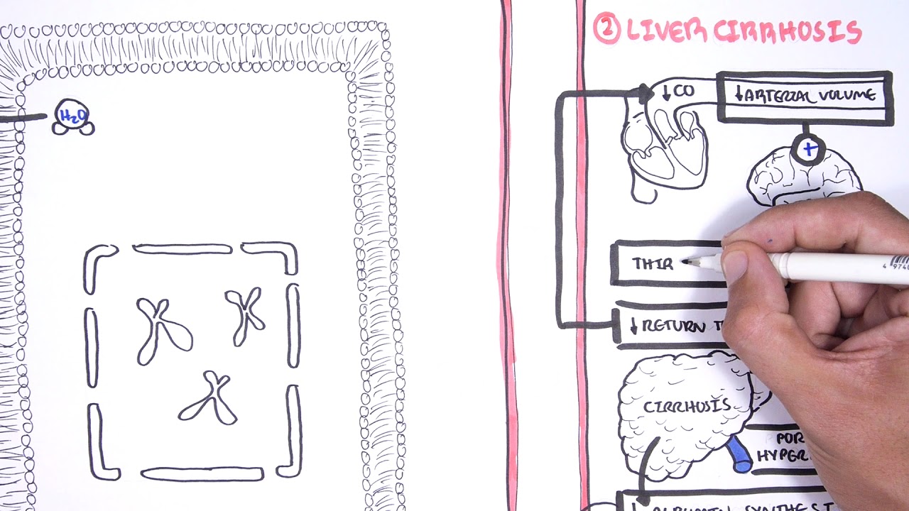 Hyponatraemia (Hyponatremia) - classification, causes, pathophysiology, treatment