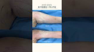 팔 리프트 성형 시술