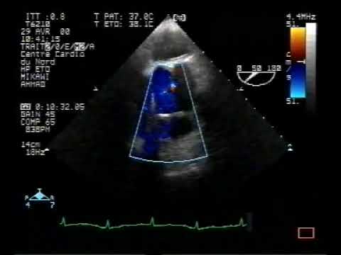 Localized dissection of the ascending aorta in TEE (3/3)