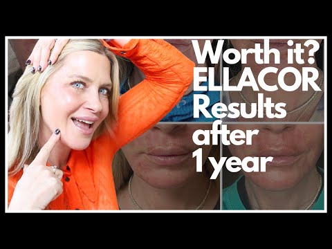 , title : 'SAGGING skin: IS ELLACOR the answer? I spent a YEAR finding out for you! With before and afters!'