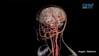 L'accident vasculaire cérébral