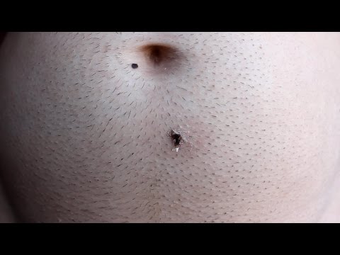 Ingrown Hair Removal Gross Videos - Armpit Face Stomach Ingrown Hair Removal Gross Videos - Armpit Face Stomach