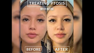 Treating Ptosis With Botox