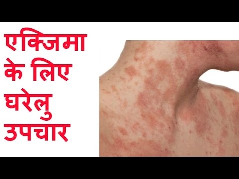Siccome fuggo di psoriasi Come curare leczema in un naso