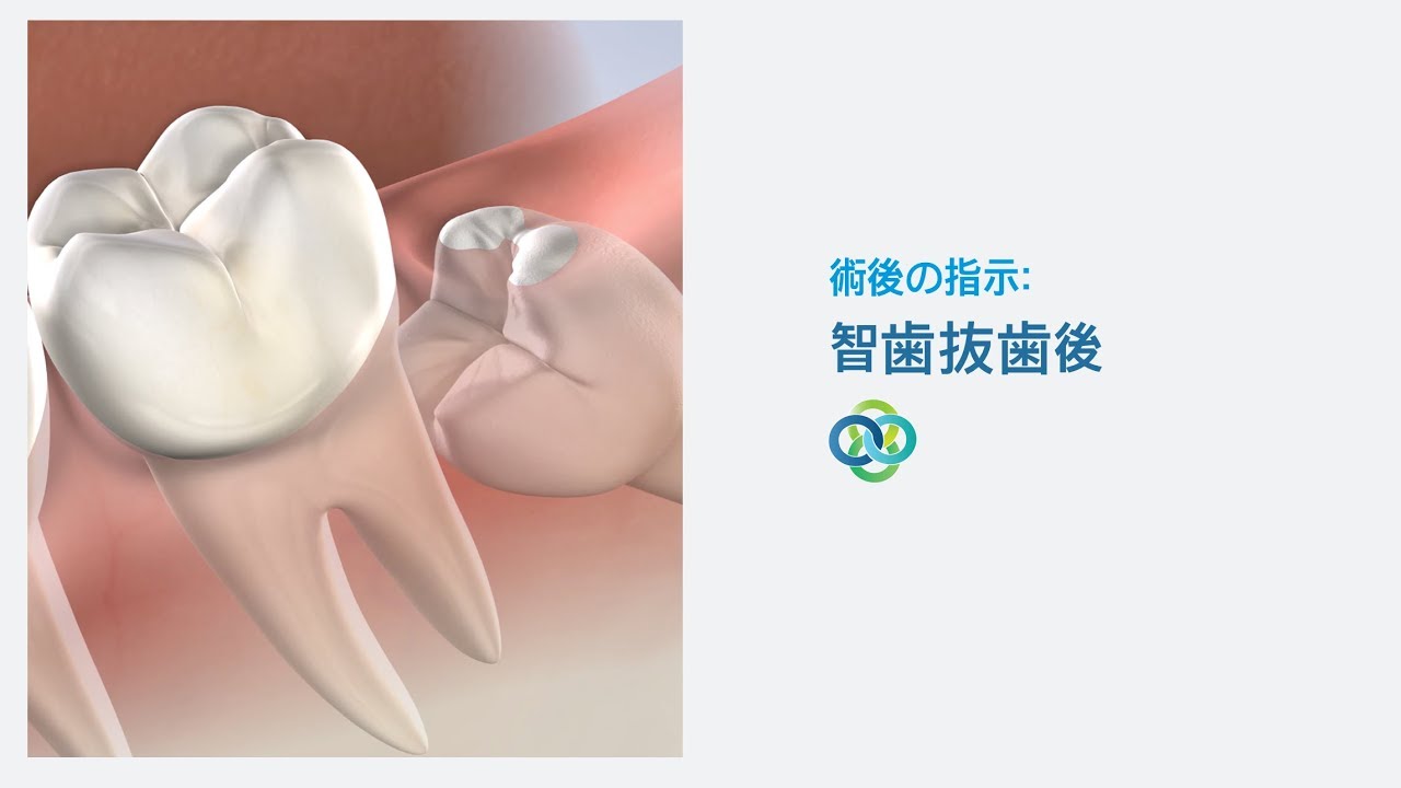術後の指示：智歯抜歯後（Oral Surgery Hawaiiにて）