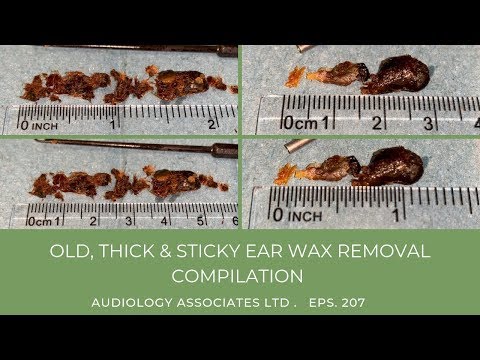 OLD, THICK & STICKY EAR WAX REMOVAL COMPILATION - EP 207