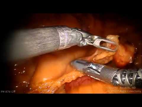 Right Colectomy ileocolic artery transection with dV Vessel Sealer
