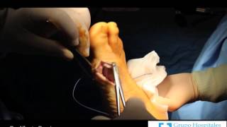 Operación Hallux Valgus (juanete)