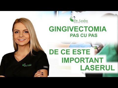 De ce apeleaza oamenii la gingivectomie si cum se realizeaza – Clinicile Dentare Dr. Leahu
