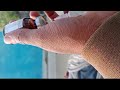 Young Indian Women 2 Butt Shot Injection Video Injectionfearcrying Hospital Viral Injectionvideo