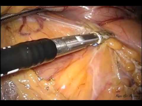 Laparo-Endoscopic Single Site (LESS) Distal Pancreatectomy and Splenectomy with an Extraction Port