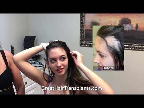 Hannah Corrective Hair Surgery Burn Patient