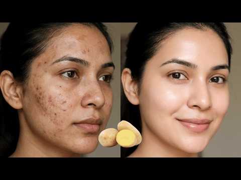 How To Use Potato To Treat Pigmentation, Dark Spots, Acne Scars Easily At Home | Home Remedie