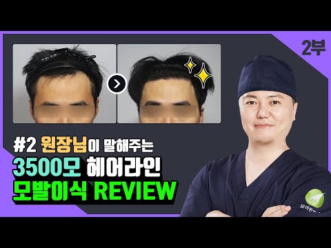 [리뷰] 모발이식 3500모 환자의 수술 후 변화 과정!(2부)