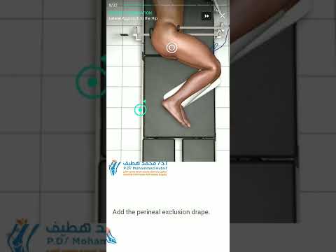 12 Steps Lateral Approach Hip In Total Hip Replacement -Patient Preparation Easy Animation