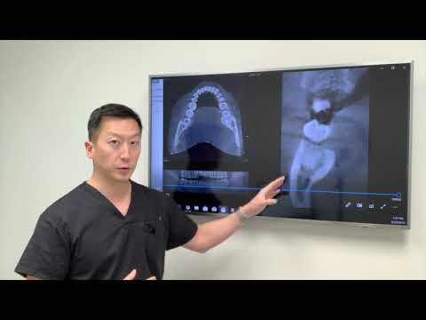 What age should you get wisdom teeth removed