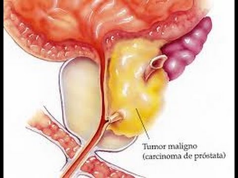 Volksmedizin mit Stein in der Prostata Übelkeit und Kopfschmerzen mit Prostatitis