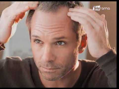 Ténicas para combatir la alopecia