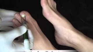 Laser Toenail Fungus Removal Treatment by San Francisco House Call Podiatrist