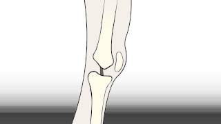 Regenexx-ACL-Non-SurgicalStemCellInjectionAlternativetoSurgery
