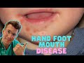 How to recognise & treat Hand Foot and Mouth Disease (Coxsackievirus) in kids | Doctor O'Donovan