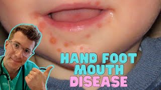 How to recognise & treat Hand Foot and Mouth Disease (Coxsackievirus) in kids | Doctor O