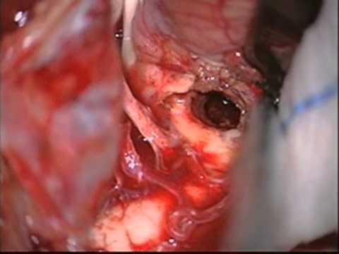 Brainstem Cavernoma - Telovelar approach