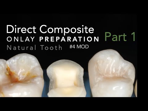 Direct Composite Onlay, Part 1: Preparation - #4 MOD Natural Tooth