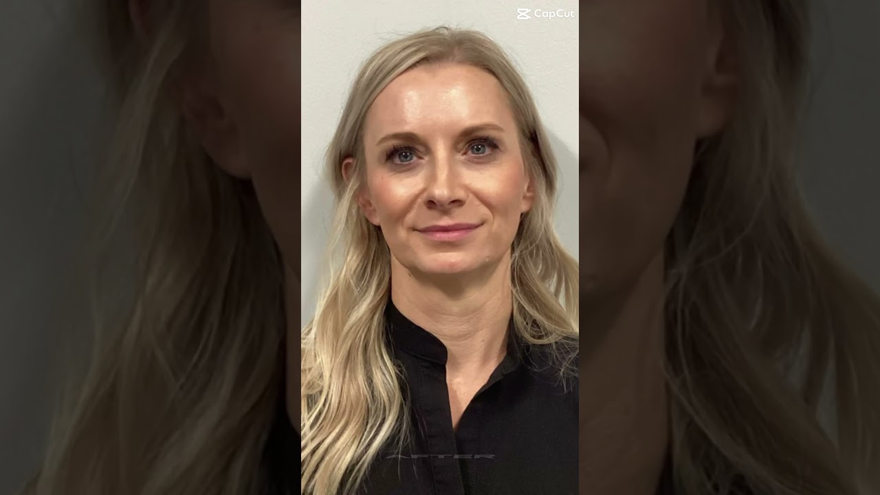 Sculptra Before & After