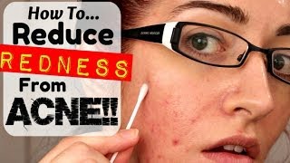 HOW TO: REMOVE REDNESS FROM ACNE &amp; SCARRING! *REQUESTED!*